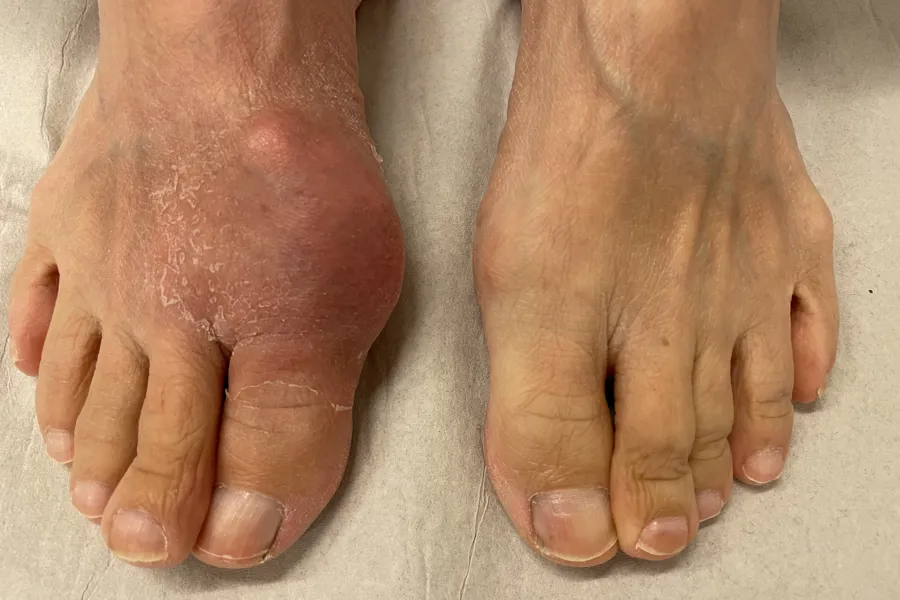 Føtter med urinsyregikt